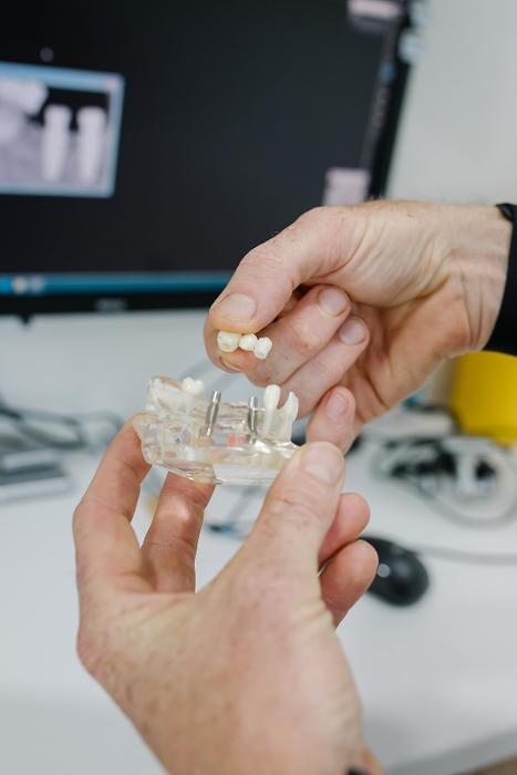 Implant supported bridge in Coffs Harbour