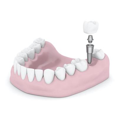 Diagram of a dental implant in coffs harbour nsw