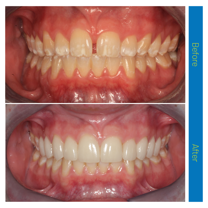 Photos of patient teeth before and after veneers in Coffs Harbour NSW