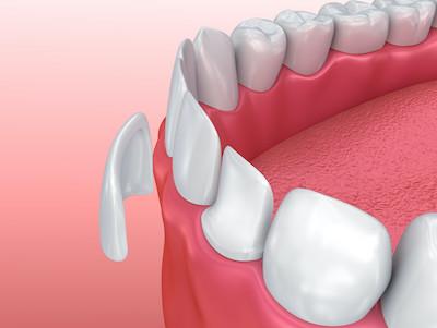 dental veneers coffs harbour