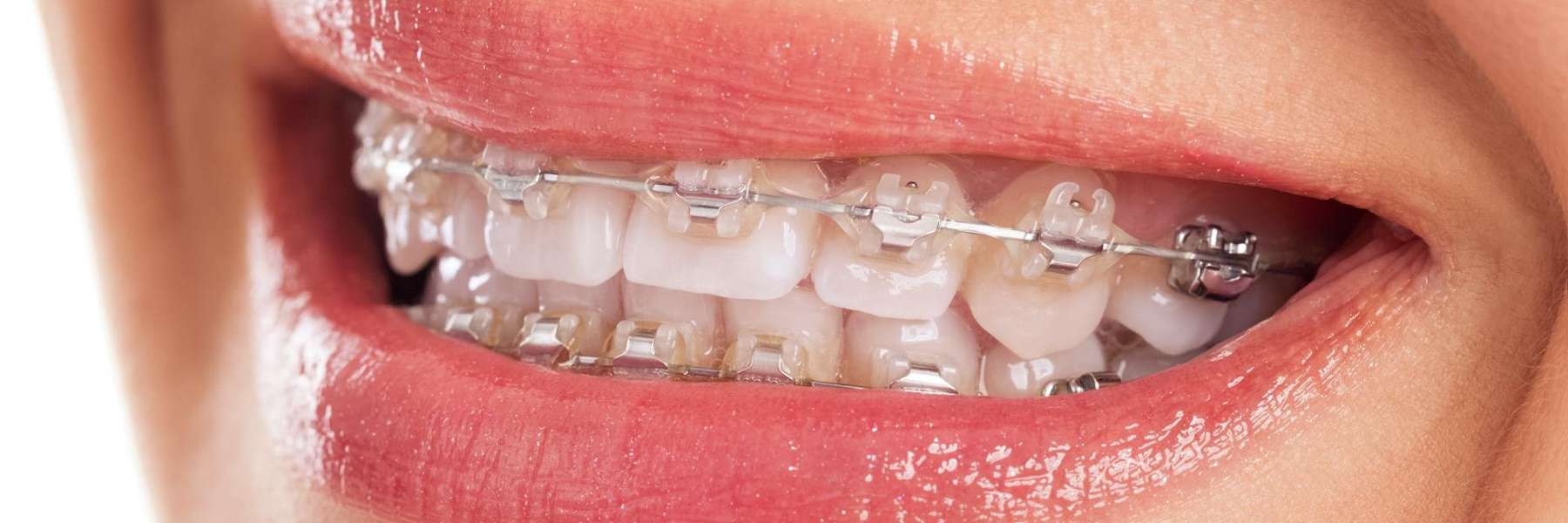A smiling woman with braces | orthodontic treatments Coffs Harbour