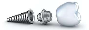 Diagram of a dental implant | Dentist Coffs Harbour
