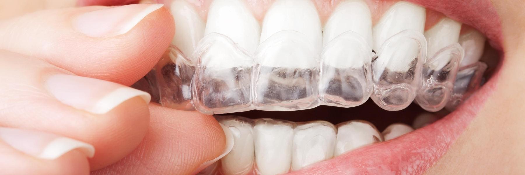 Woman putting in Invisalign in Coffs Harbour