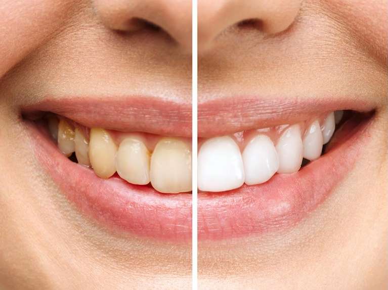 before and after teeth whitening in coffs harbour