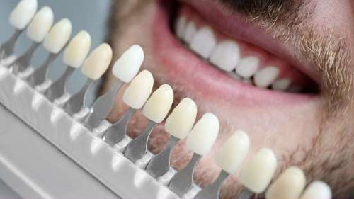 patient discussing teeth whitening in coffs harbour with dentist