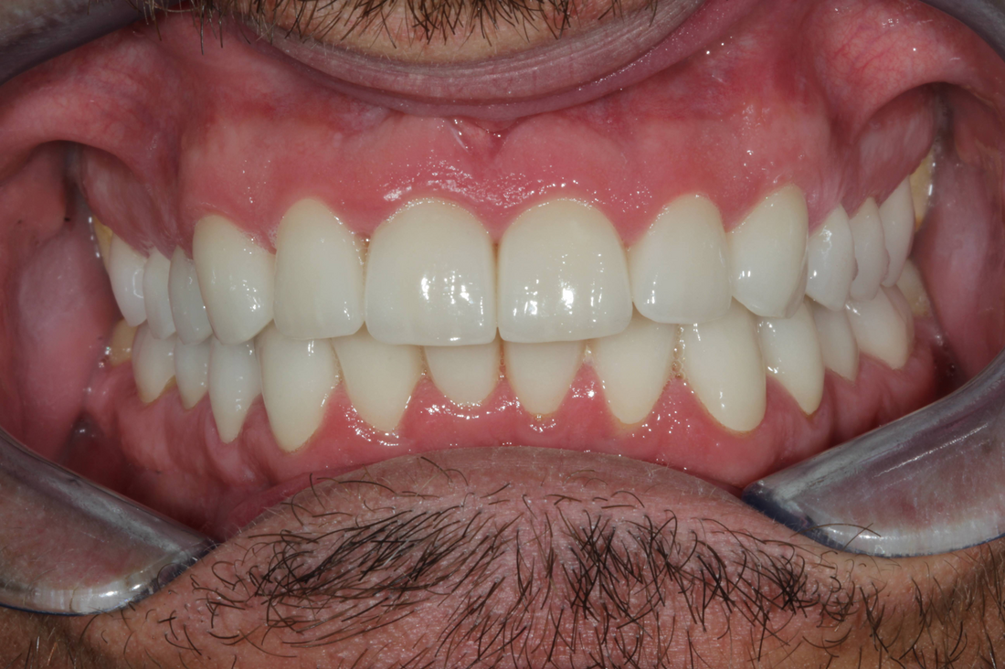 after dental treatment a patient's smile is bright and white