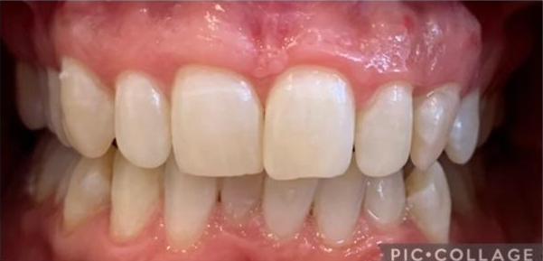 patient after zoom whitening in coffs harbour