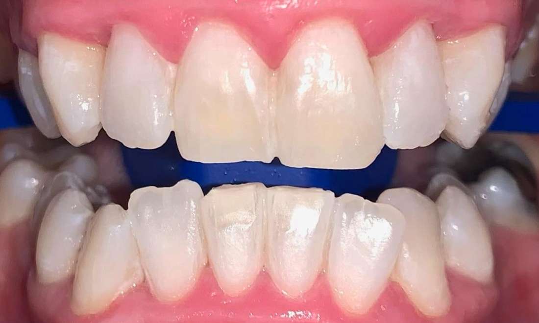 Coffs Harbour patient after getting his teeth whitened