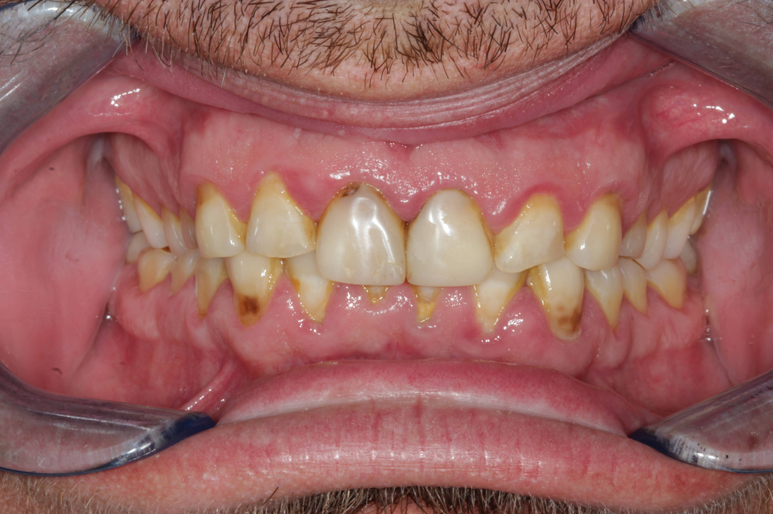 smile with severe erosion and abrasion from teeth grinding and acid reflux