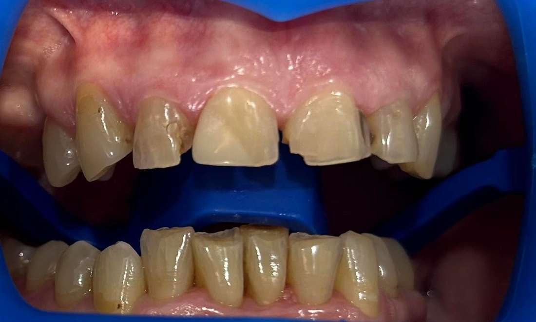 before teeth whitening in Coffs Harbour