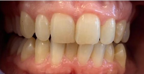 Patient before zoom whitening in coffs harbour