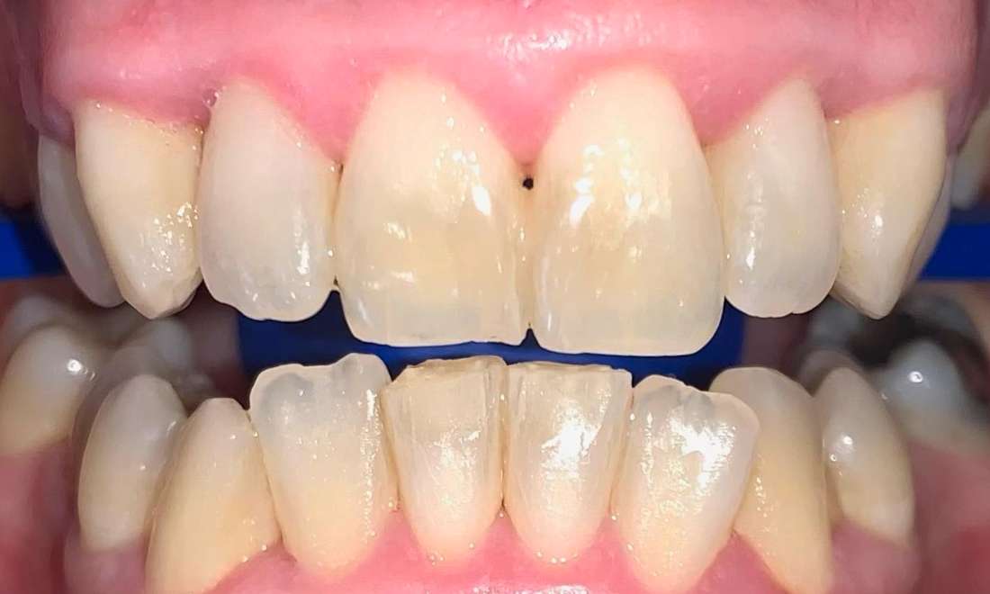 Patient teeth before receiving the zoom teeth whitening procedure