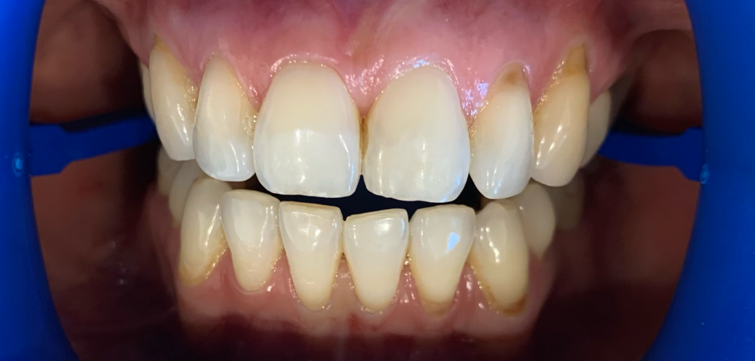 patient's smile before teeth whitening coffs harbour