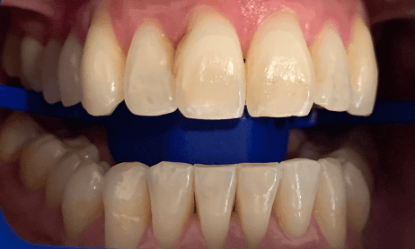 Patient teeth before zoom in chair teeth whitening