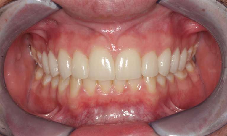 10-Porcelain-Veneers-After-Image