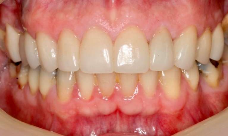 patient after their new smile with dental crowns in coffs harbour