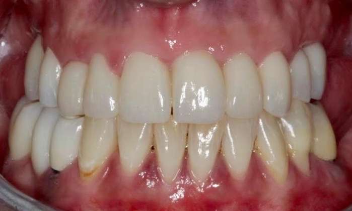 Complex-Treatment-Implants-Crowns-and-Whitening-After-Image
