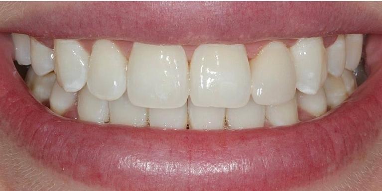 Results from Icon Infiltration teeth whitening in Coffs Harbour NSW