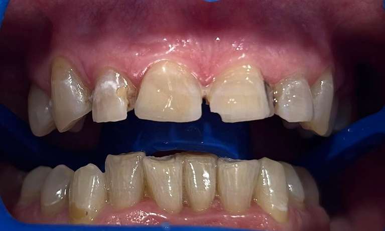 In-Chair-Teeth-Whitening-After-Image