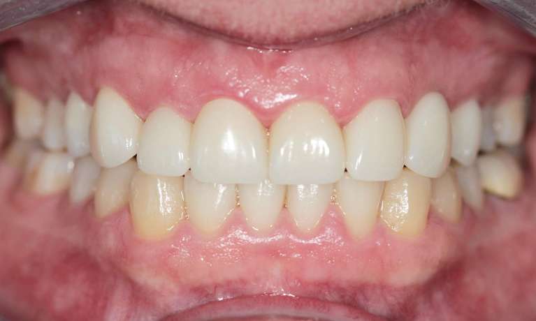 patient after custom crown and bridge in coffs harbour