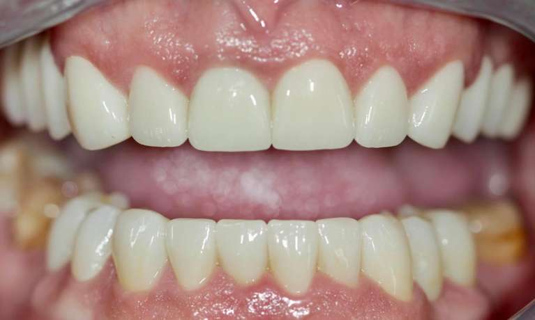 Porcelain-Crowns-After-Image