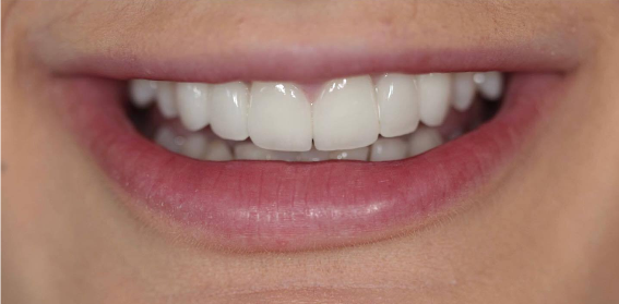 Returned-Patient-s-Smile-Using-Dental-Bridges-After-Image