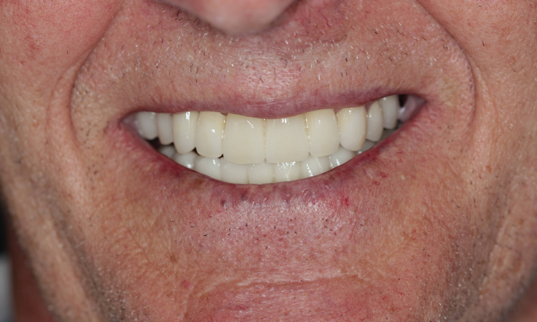 new, better-fitting upper and lower bridges at coffs harbour dentist