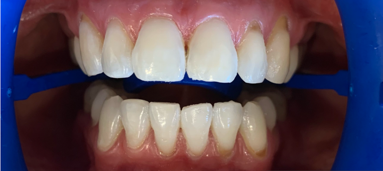 patient's bright smile after teeth whitening coffs harbour