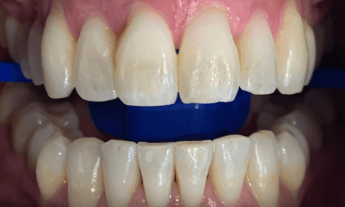 Patient smile after coffs harbour teeth whitening procedure
