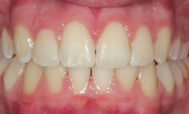 patient after invisalign treatment in coffs harbour