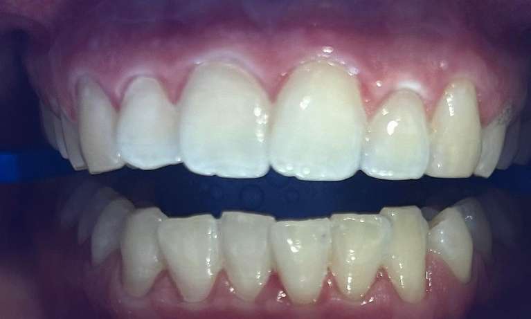 Teeth-Whitening-After-Image