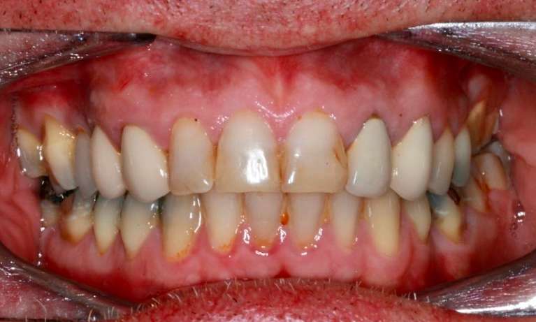 patient before their new smile with dental crowns in coffs harbour