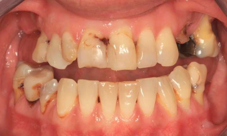 Complex-Treatment-Implants-Crowns-and-Whitening-Before-Image