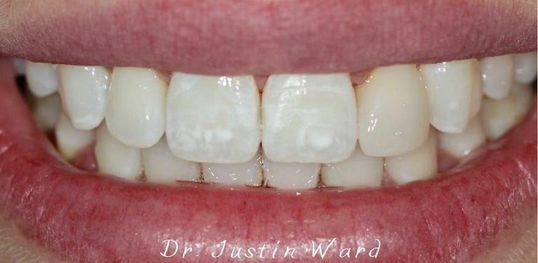 Close up of patients smile before icon infiltration at dental clinic in Coffs Harbour NSW