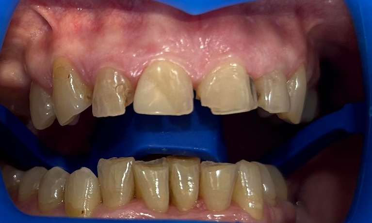 In-Chair-Teeth-Whitening-Before-Image
