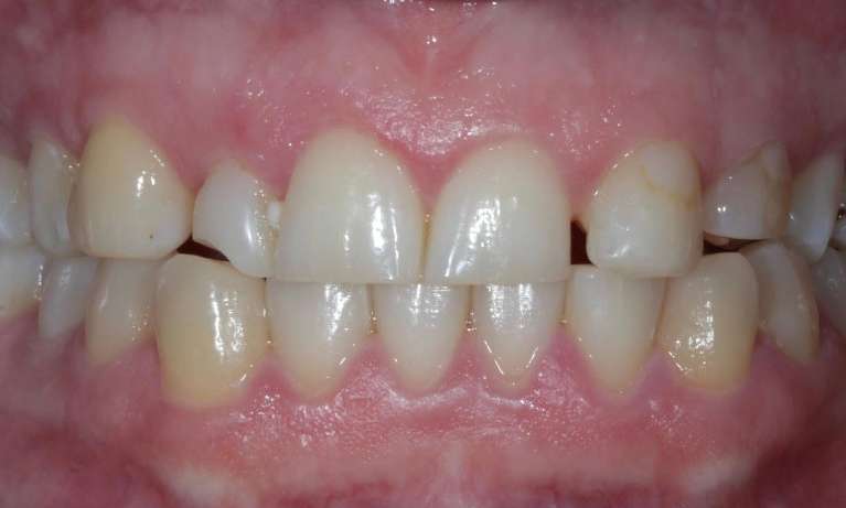 patient before custom crown and bridge in coffs harbour