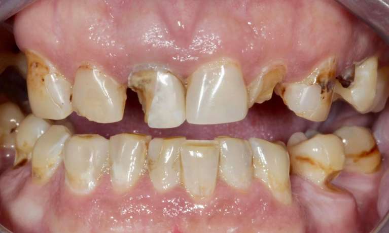 Porcelain-Crowns-Before-Image