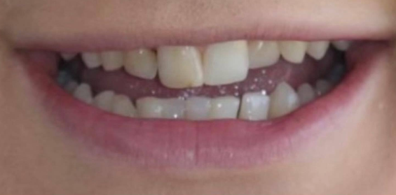 Returned-Patient-s-Smile-Using-Dental-Bridges-Before-Image