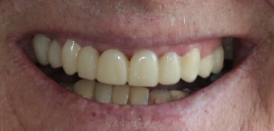 man with poor fitting upper and lower dentures