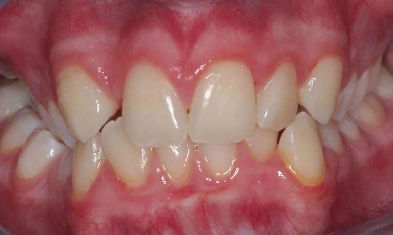 patient before invisalign treatment in coffs harbour