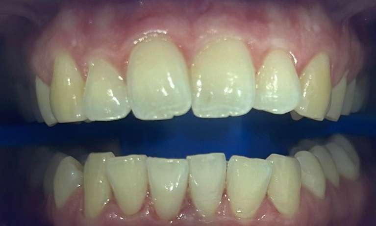 Teeth-Whitening-Before-Image